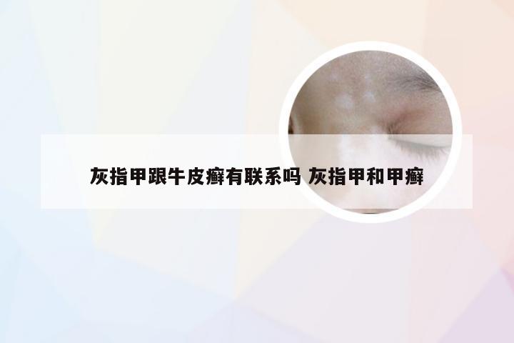 灰指甲跟牛皮癣有联系吗 灰指甲和甲癣