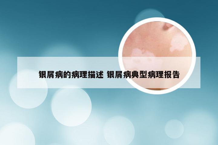 银屑病的病理描述 银屑病典型病理报告