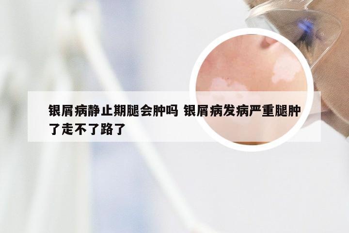 银屑病静止期腿会肿吗 银屑病发病严重腿肿了走不了路了