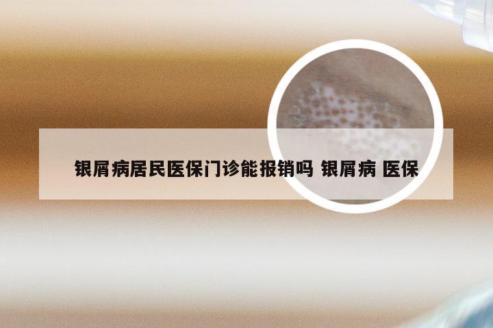 银屑病居民医保门诊能报销吗 银屑病 医保