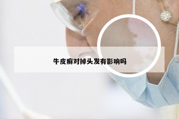 牛皮癣对掉头发有影响吗