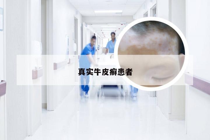 真实牛皮癣患者