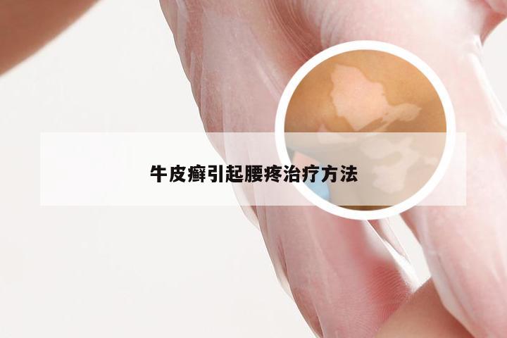 牛皮癣引起腰疼治疗方法