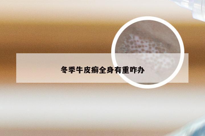 冬季牛皮癣全身有重咋办