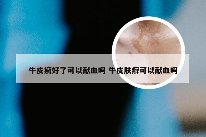 牛皮癣好了可以献血吗 牛皮肤癣可以献血吗