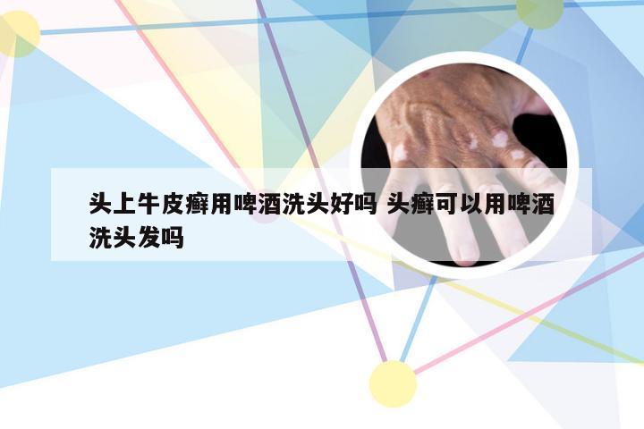 头上牛皮癣用啤酒洗头好吗 头癣可以用啤酒洗头发吗