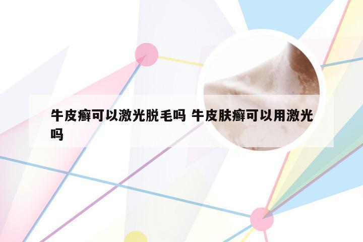 牛皮癣可以激光脱毛吗 牛皮肤癣可以用激光吗