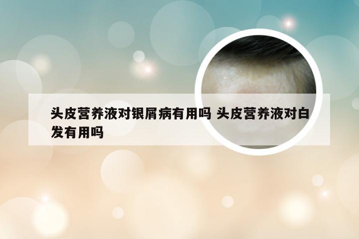 头皮营养液对银屑病有用吗 头皮营养液对白发有用吗