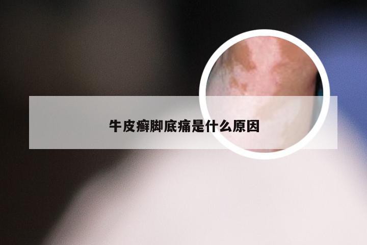 牛皮癣脚底痛是什么原因