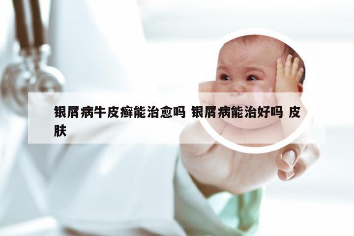 银屑病牛皮癣能治愈吗 银屑病能治好吗 皮肤
