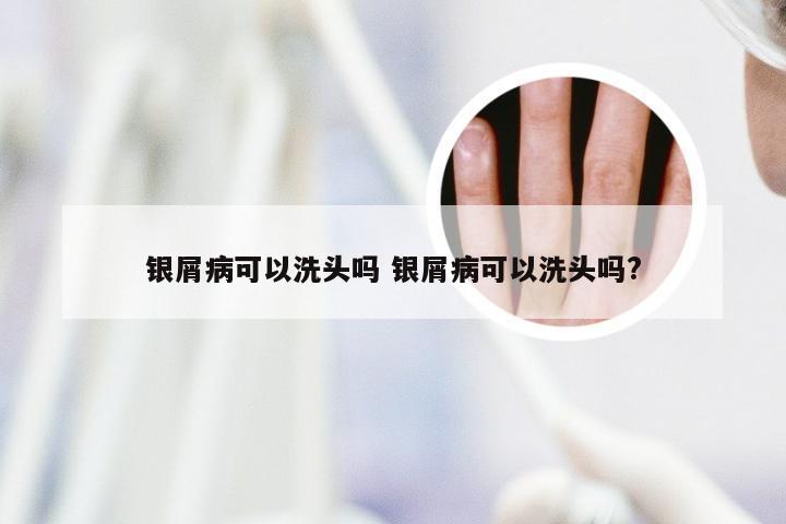 银屑病可以洗头吗 银屑病可以洗头吗?