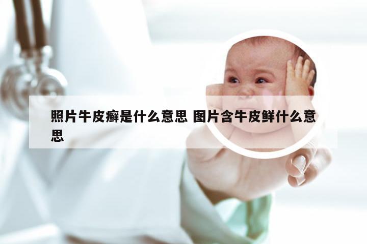 照片牛皮癣是什么意思 图片含牛皮鲜什么意思