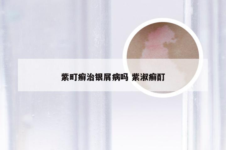 紫町癣治银屑病吗 紫淑癣酊