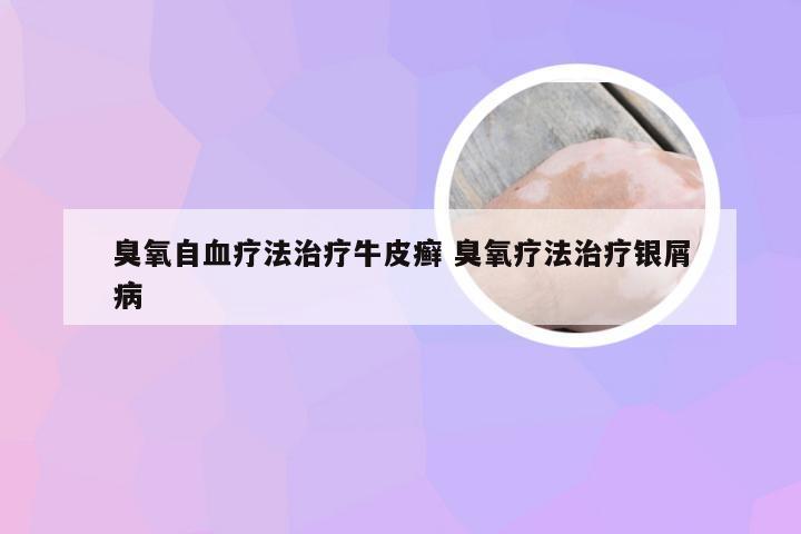 臭氧自血疗法治疗牛皮癣 臭氧疗法治疗银屑病