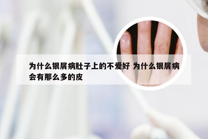 为什么银屑病肚子上的不爱好 为什么银屑病会有那么多的皮