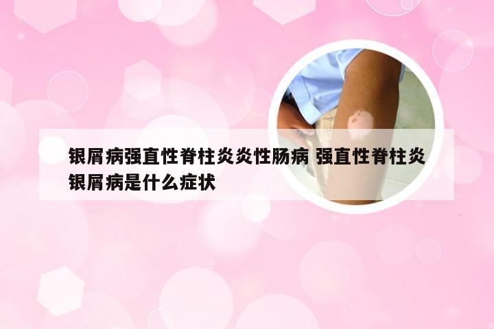 银屑病强直性脊柱炎炎性肠病 强直性脊柱炎银屑病是什么症状