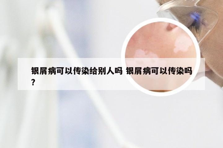 银屑病可以传染给别人吗 银屑病可以传染吗?