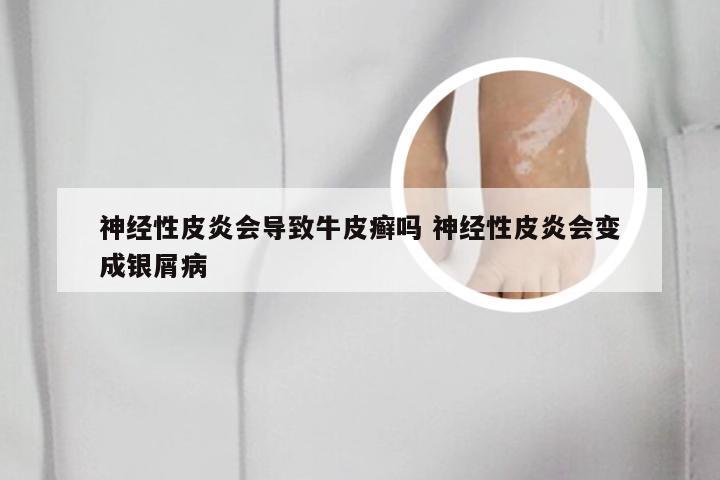 神经性皮炎会导致牛皮癣吗 神经性皮炎会变成银屑病