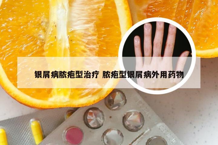 银屑病脓疱型治疗 脓疱型银屑病外用药物