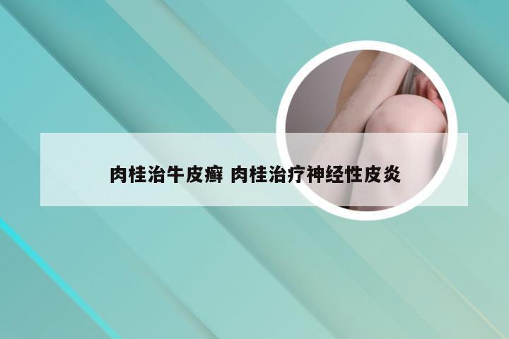 肉桂治牛皮癣 肉桂治疗神经性皮炎