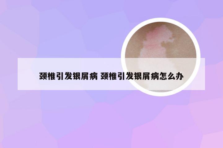颈椎引发银屑病 颈椎引发银屑病怎么办