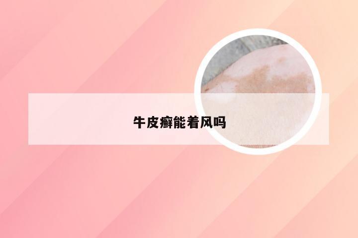 牛皮癣能着风吗
