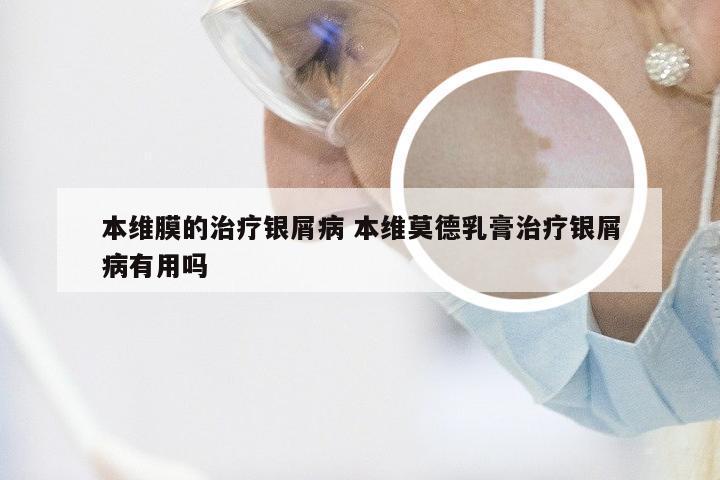 本维膜的治疗银屑病 本维莫德乳膏治疗银屑病有用吗