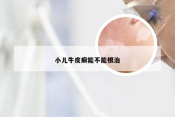 小儿牛皮癣能不能根治