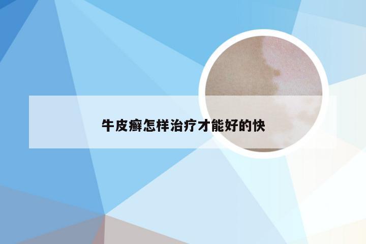牛皮癣怎样治疗才能好的快