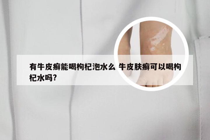 有牛皮癣能喝枸杞泡水么 牛皮肤癣可以喝枸杞水吗?