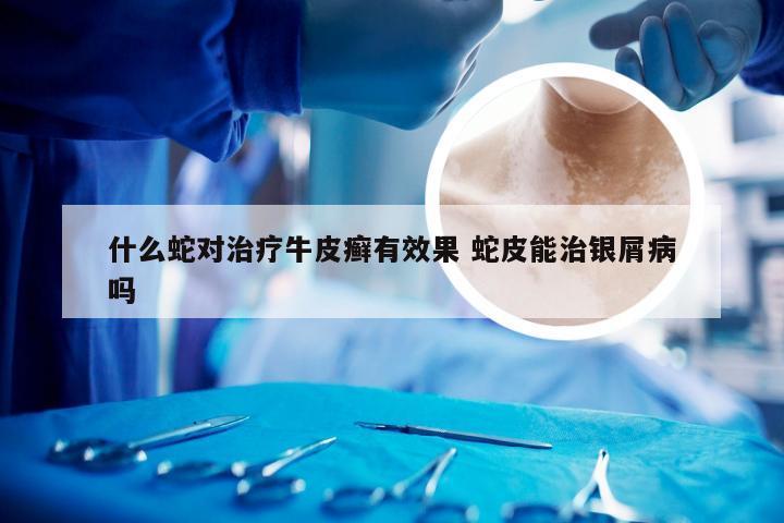 什么蛇对治疗牛皮癣有效果 蛇皮能治银屑病吗
