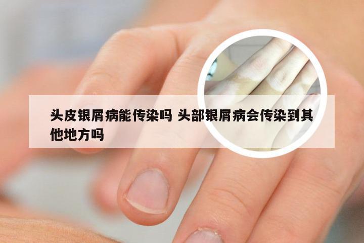 头皮银屑病能传染吗 头部银屑病会传染到其他地方吗