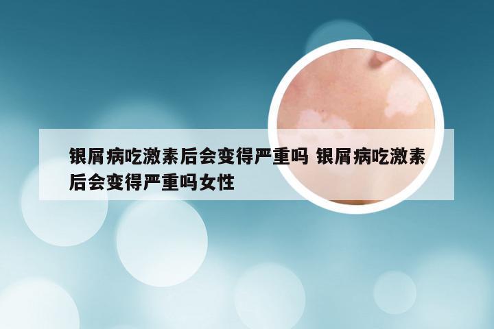 银屑病吃激素后会变得严重吗 银屑病吃激素后会变得严重吗女性