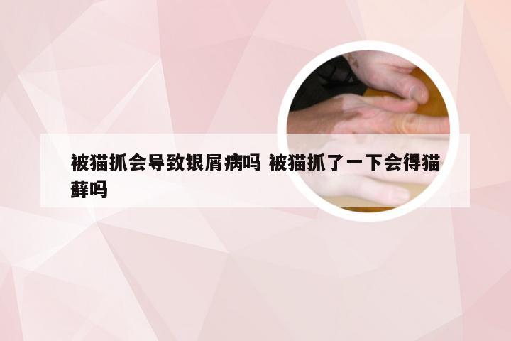 被猫抓会导致银屑病吗 被猫抓了一下会得猫藓吗