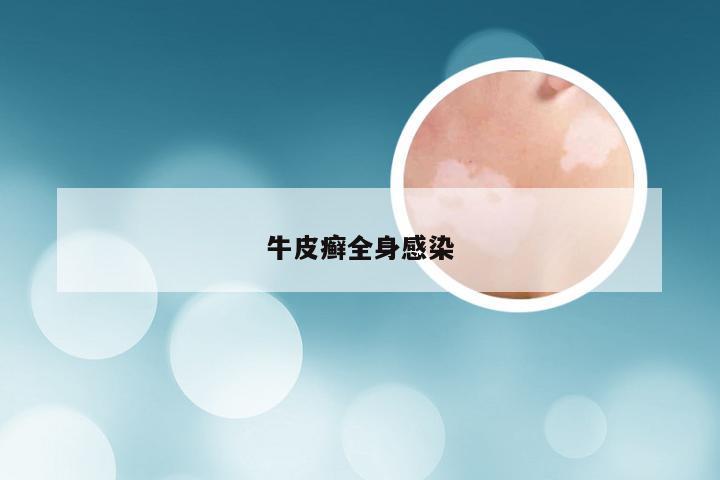 牛皮癣全身感染