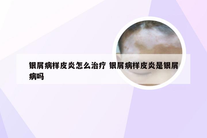 银屑病样皮炎怎么治疗 银屑病样皮炎是银屑病吗