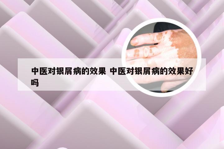 中医对银屑病的效果 中医对银屑病的效果好吗
