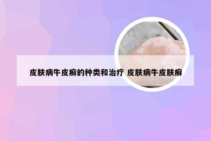 皮肤病牛皮癣的种类和治疗 皮肤病牛皮肤癣