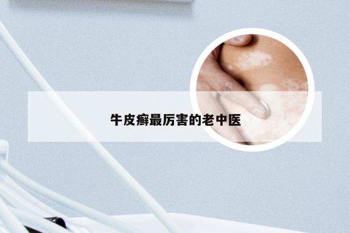 牛皮癣最厉害的老中医