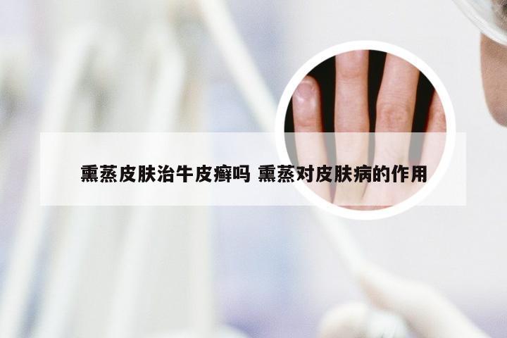 熏蒸皮肤治牛皮癣吗 熏蒸对皮肤病的作用