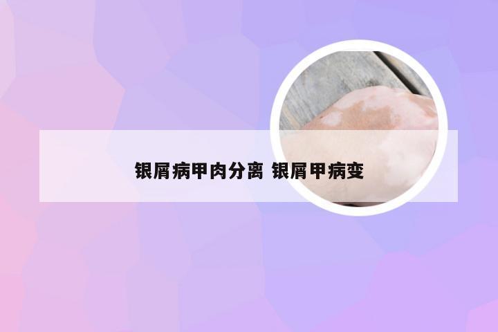 银屑病甲肉分离 银屑甲病变