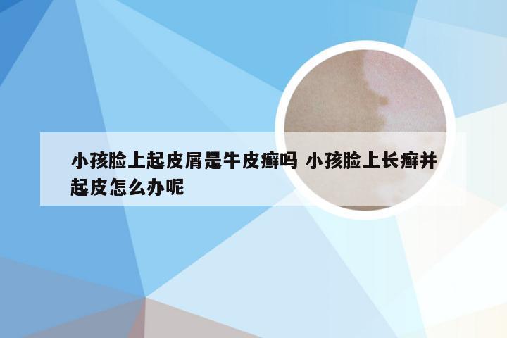 小孩脸上起皮屑是牛皮癣吗 小孩脸上长癣并起皮怎么办呢