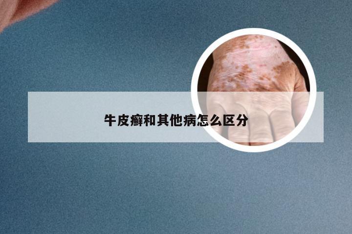 牛皮癣和其他病怎么区分