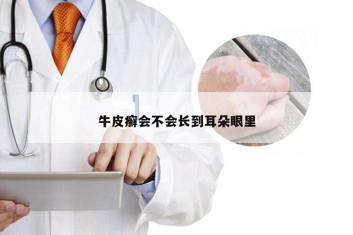 牛皮癣会不会长到耳朵眼里