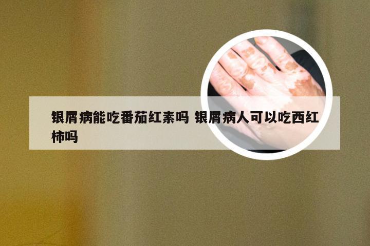 银屑病能吃番茄红素吗 银屑病人可以吃西红柿吗