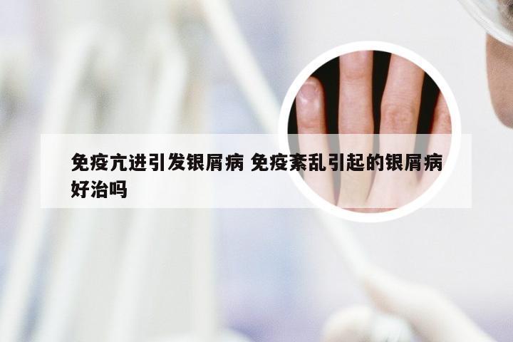 免疫亢进引发银屑病 免疫紊乱引起的银屑病好治吗