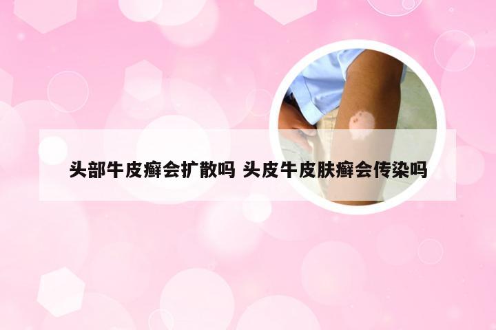 头部牛皮癣会扩散吗 头皮牛皮肤癣会传染吗