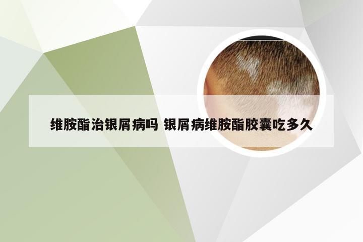 维胺酯治银屑病吗 银屑病维胺酯胶囊吃多久