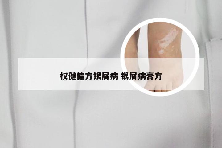 权健偏方银屑病 银屑病膏方