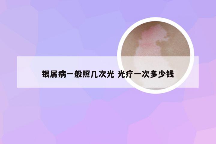 银屑病一般照几次光 光疗一次多少钱